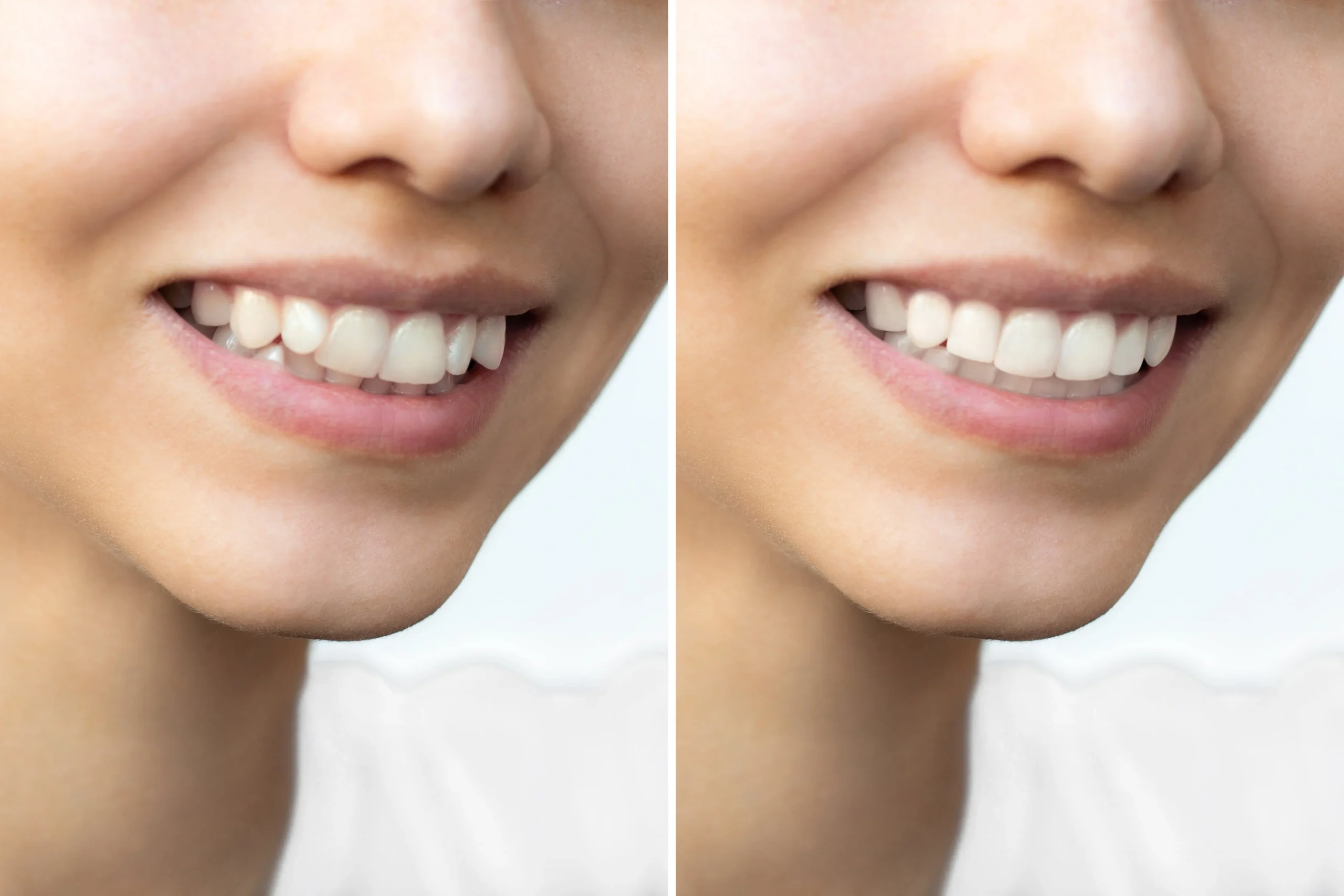A woman smiling widely showing her bright teeth