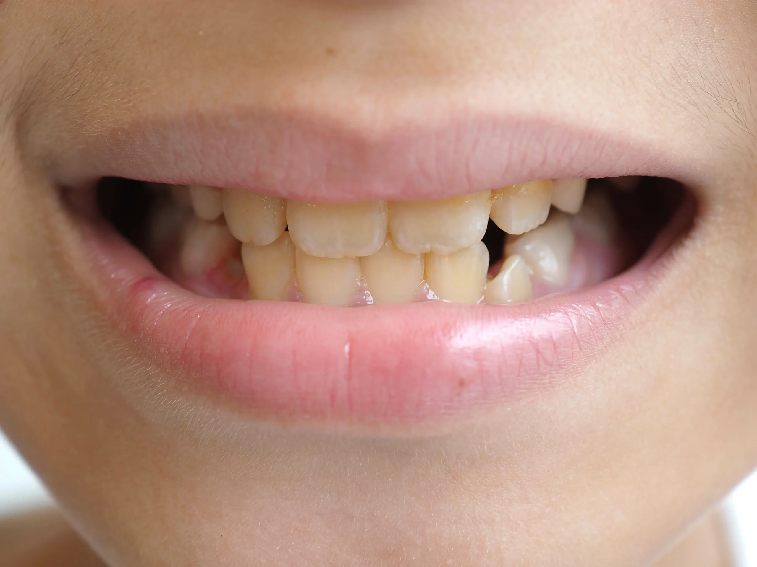 A person with yellow teeth